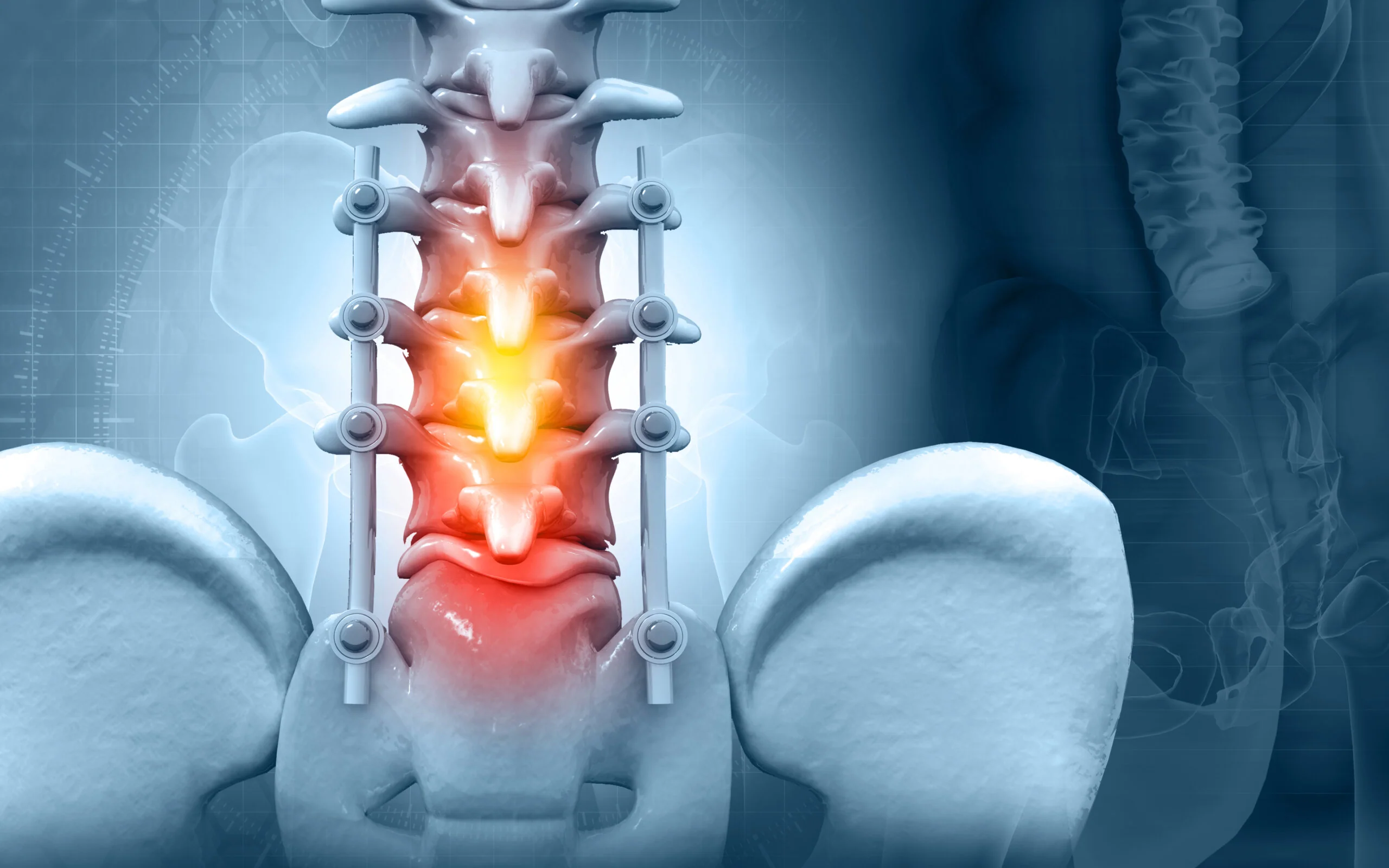 spinal stenosis